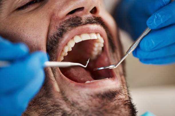Best Emergency Root Canal Therapy in Salisbury, NC